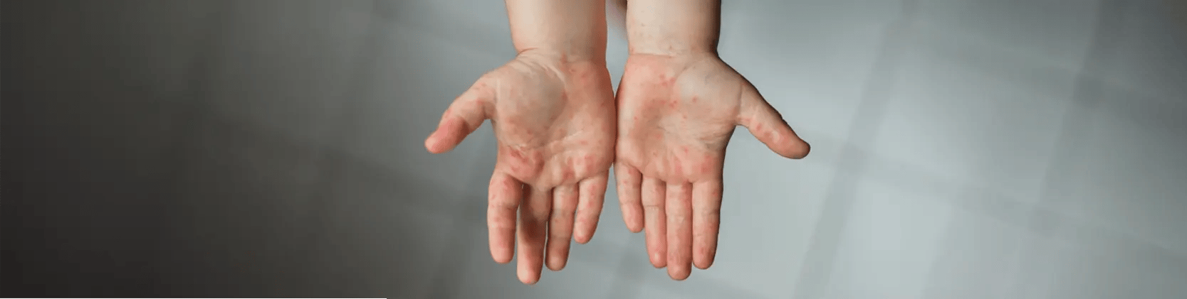 Imagen interna - Nota Web - Virus Coxsackie (enfermedad pie, mano, boca) - JUN25 - EF